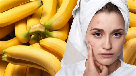 Can B Vitamins Cause Acne? And Why Do Bananas Always Look So Happy?