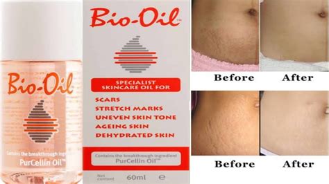 Does Bio Oil Work on Old Stretch Marks: A Journey Through Time and Skin