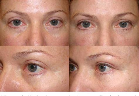 Is Periorbital Fat Loss Reversible? Exploring the Myths and Realities of Eye Rejuvenation