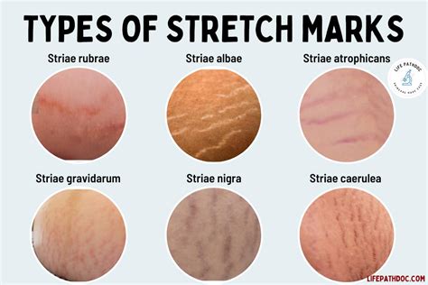 Why Do Stretch Marks Itch: Exploring the Mysteries of Skin and Sensation